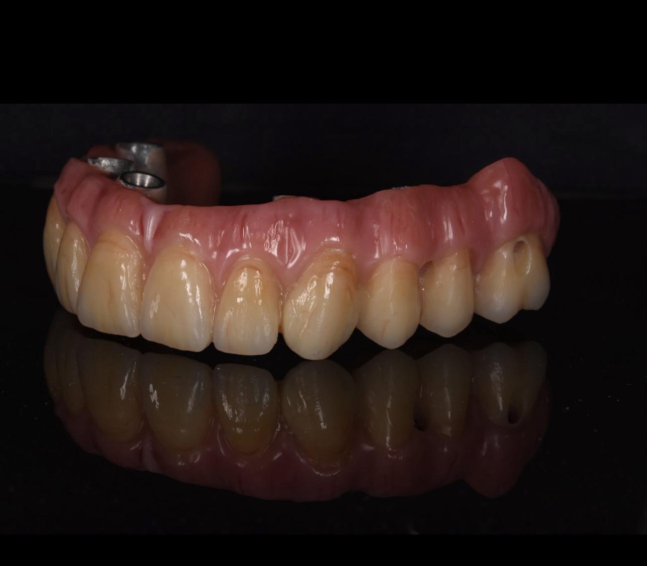 Implantat – Artem Dental Lab